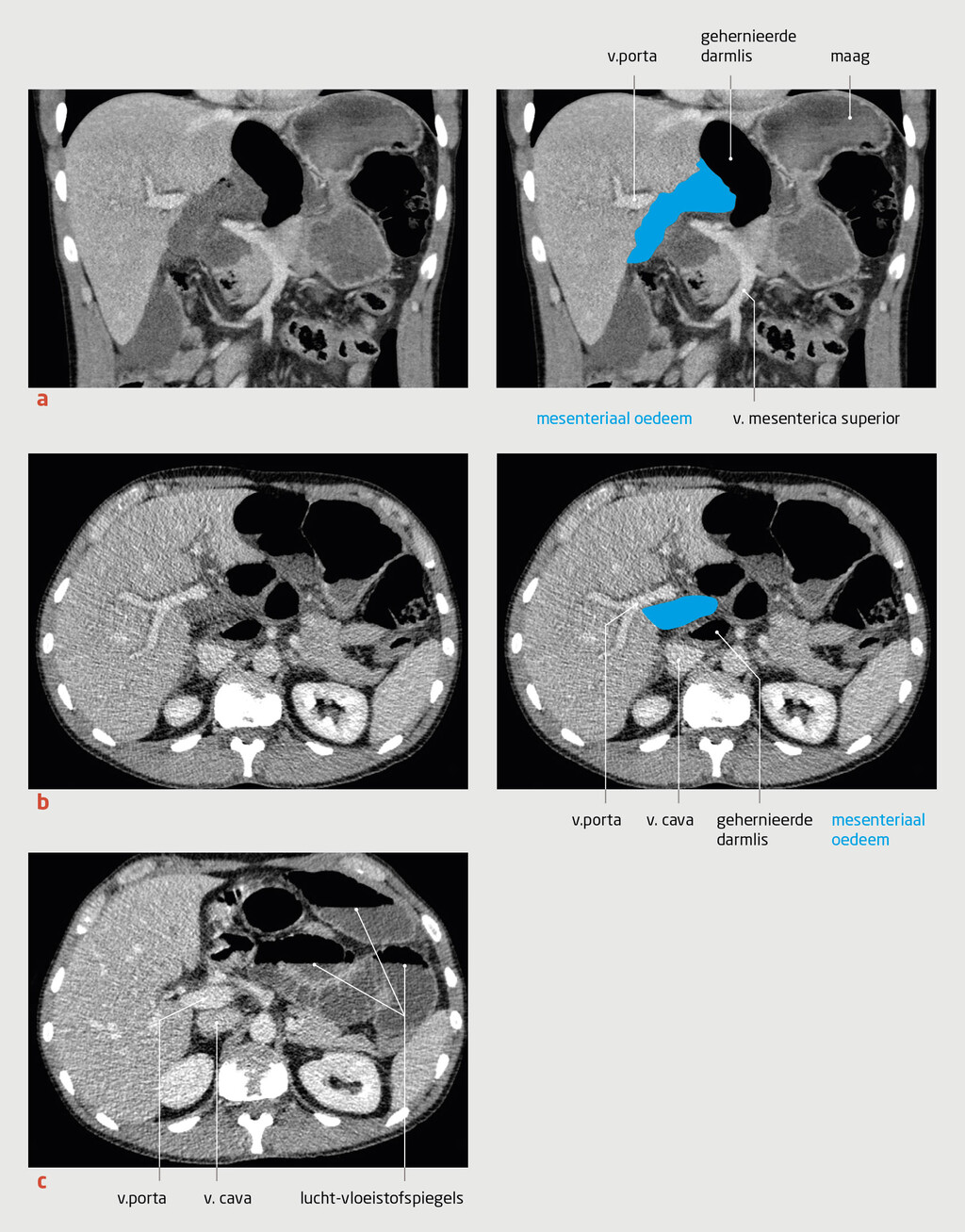 Figuur 2 | Herniatie van dunne darm door het foramen van Winslow