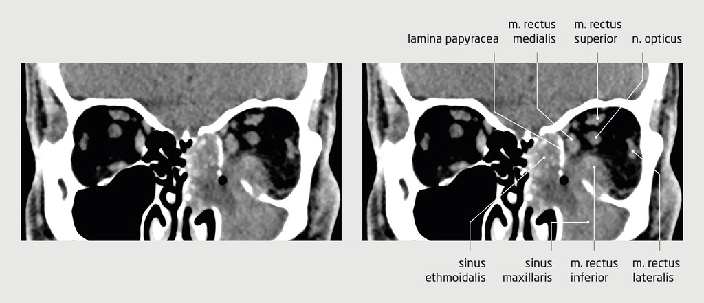Figuur 2 | CT-scan van de orbita