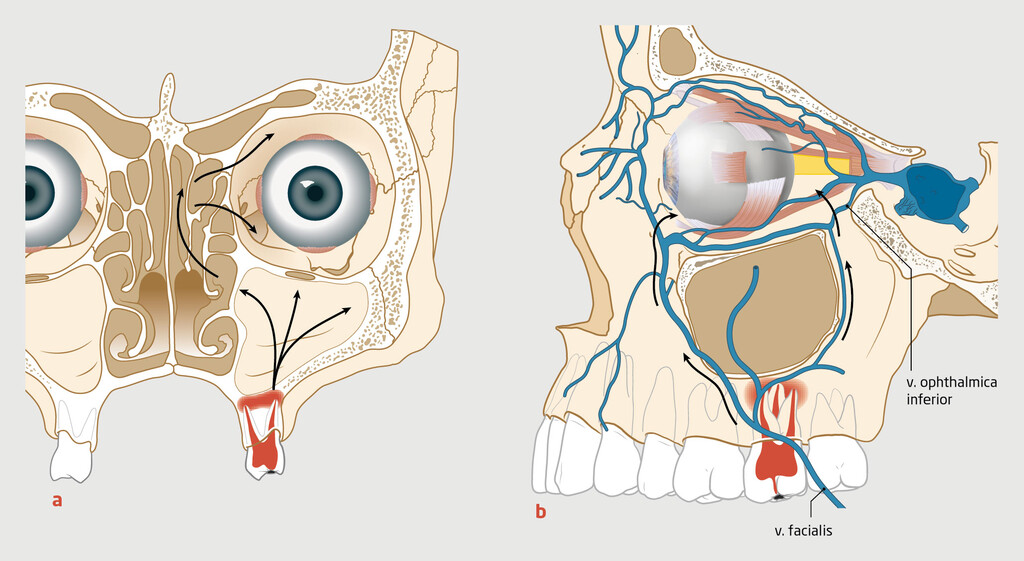 Figuur 4 | Van dentogene infectie naar een orbitale cellulitis