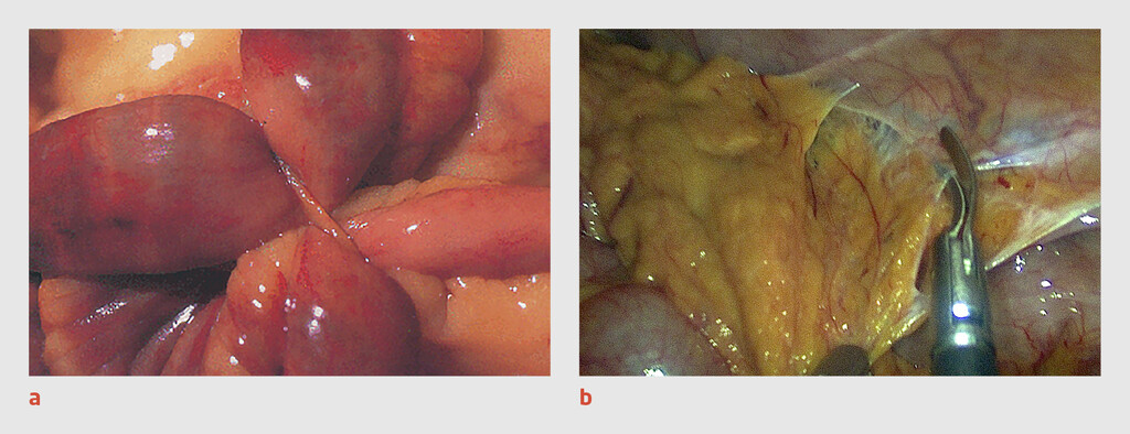 Figuur 2 | Voorbeelden van het macroscopische beeld van adhesies