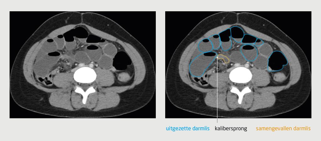 Figuur 3 | CT-beeld bij een strengileus