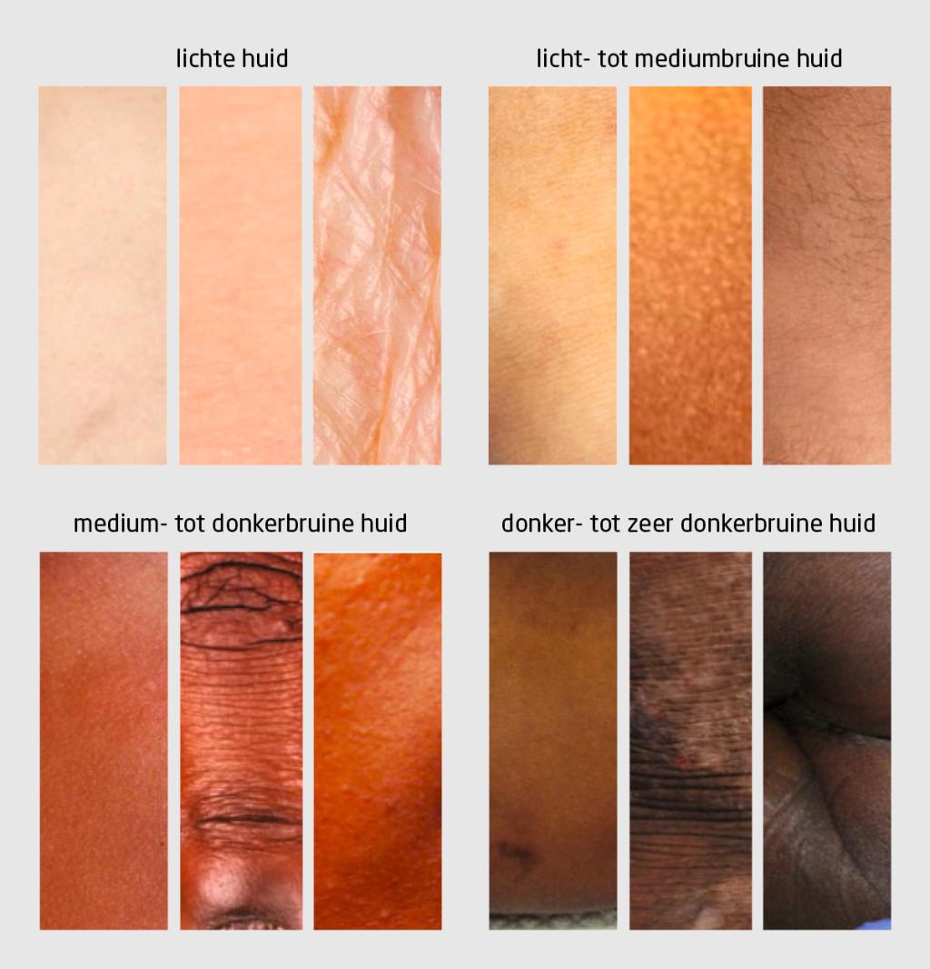 Figuur 1 | Indeling van huidtinten