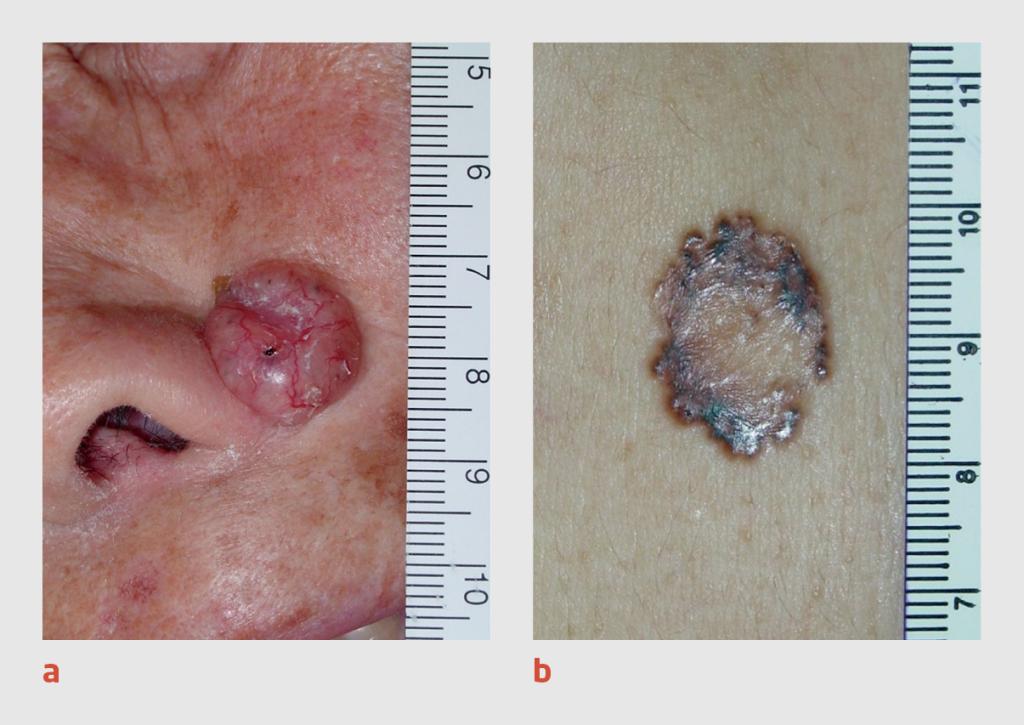 Figuur 2 | Ongepigmenteerd en gepigmenteerd basaalcelcarcinoom