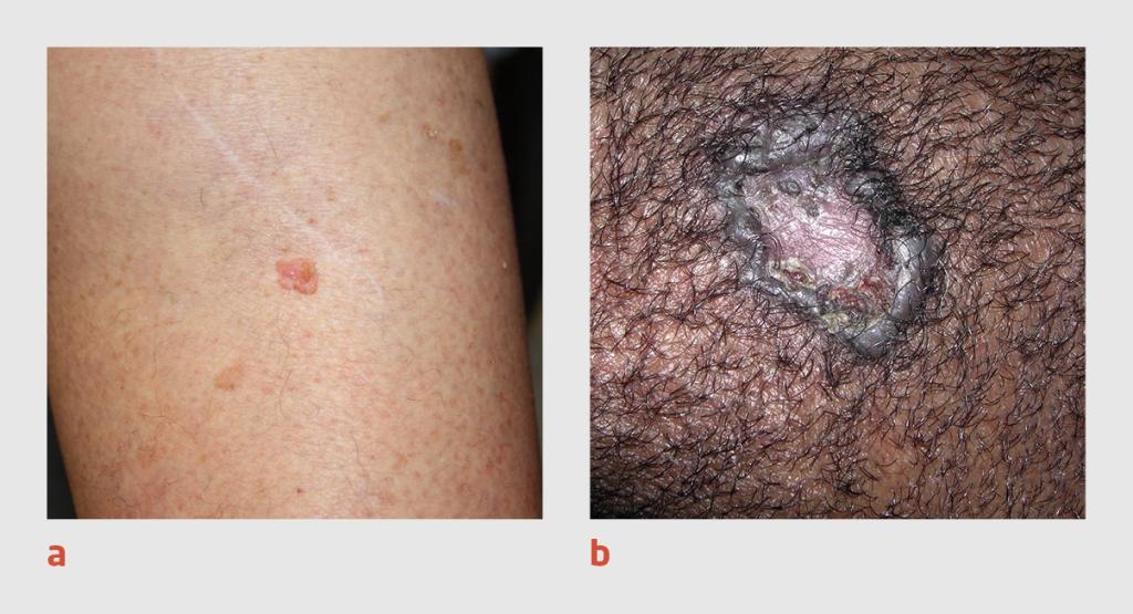 Figuur 3 | Plaveiselcelcarcinoom op lichte en donkere huid