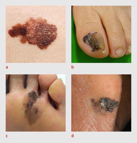 [D7332_F4]Figuur 4 | Voorbeelden van melanomen bij mensen met lichte en donkere huid