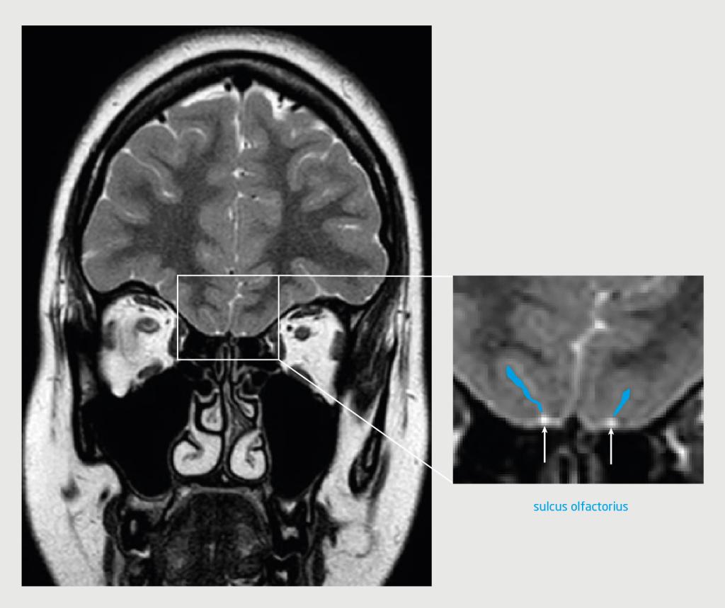 Figuur 1 | De hersenen van de patiënte met congenitale anosmie
