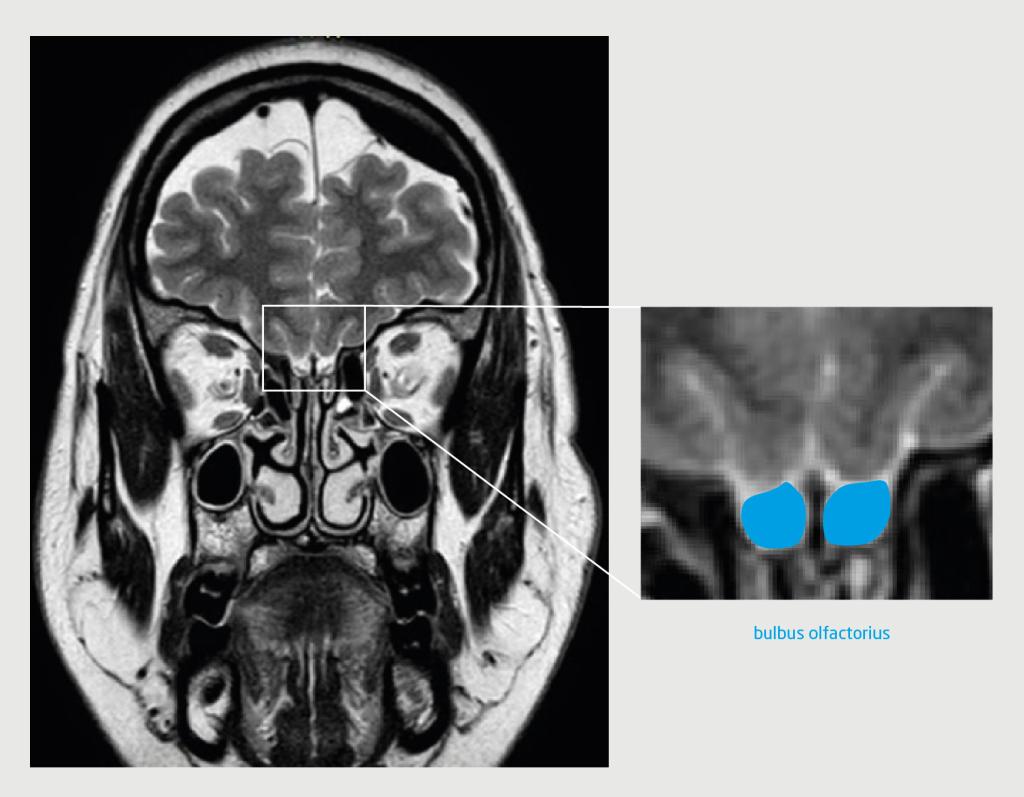Figuur 2 | De hersenen van de patiënte met intracraniële hypertensie