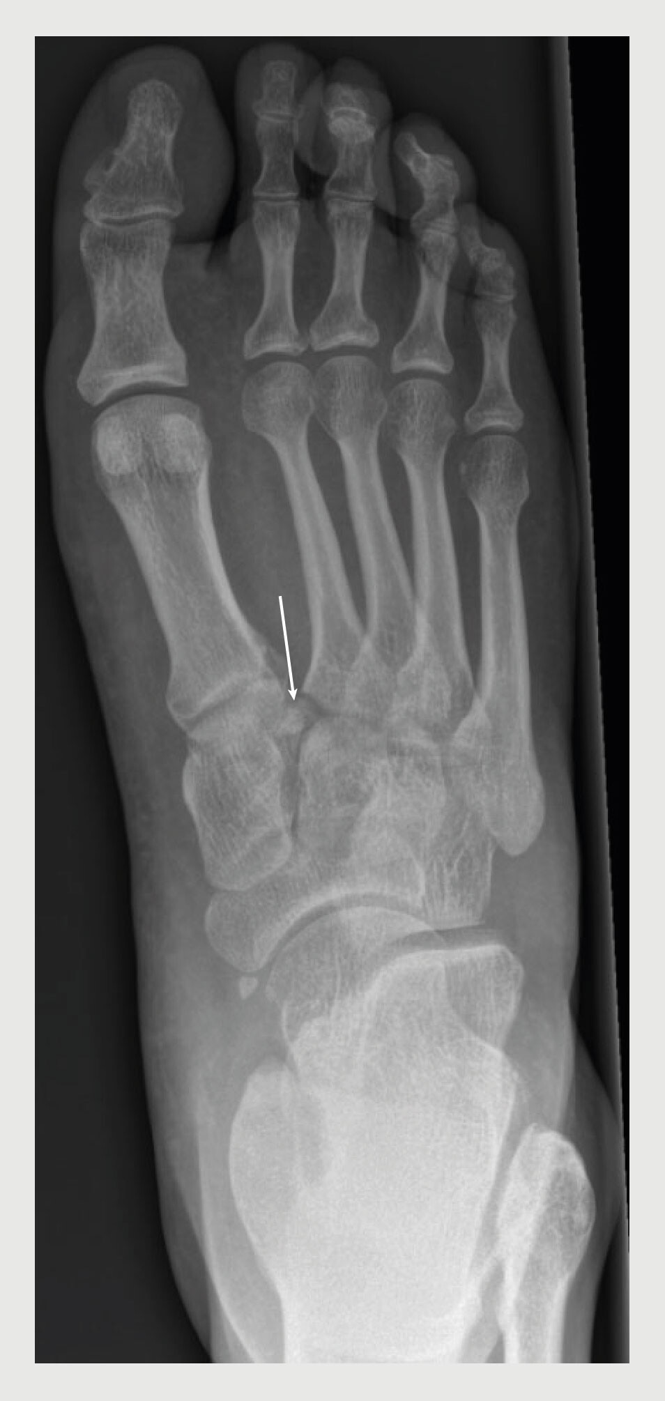 Figuur 2 | Röntgenfoto van voet van de patiënt