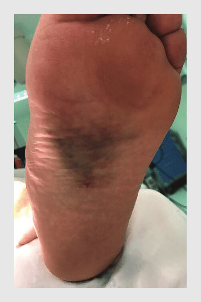 Figuur 3 | Plantair hematoom