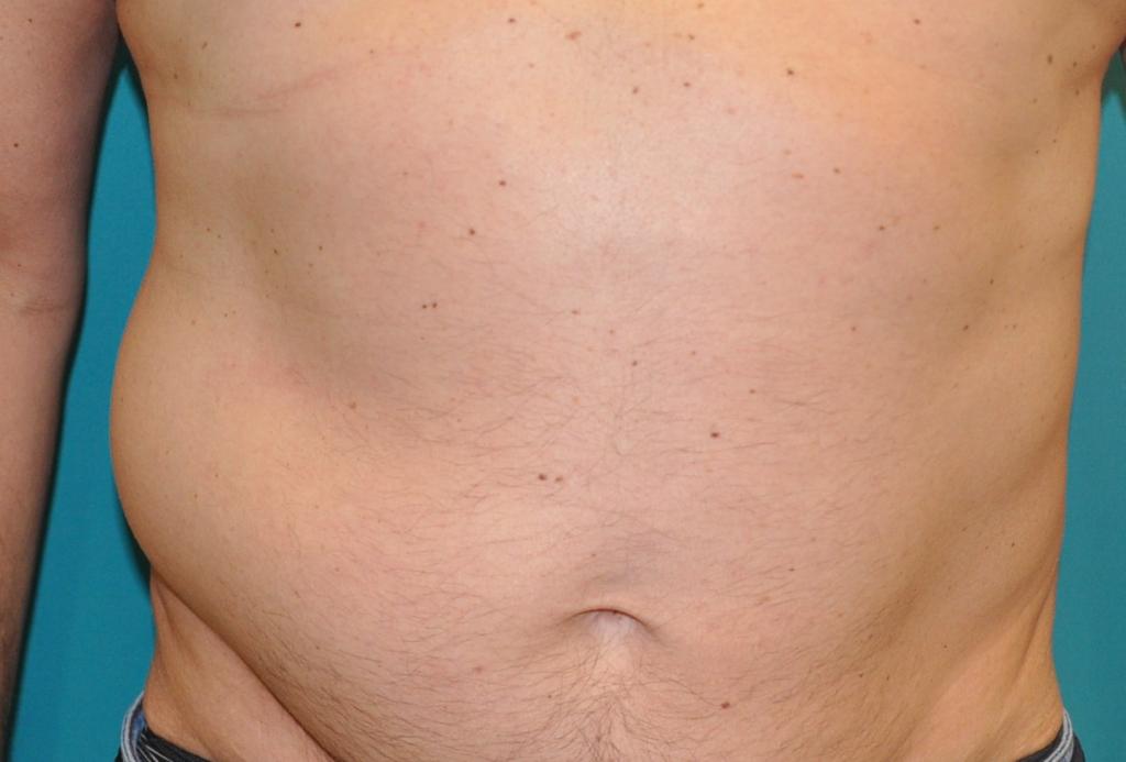 Man met uitstulping op de buik