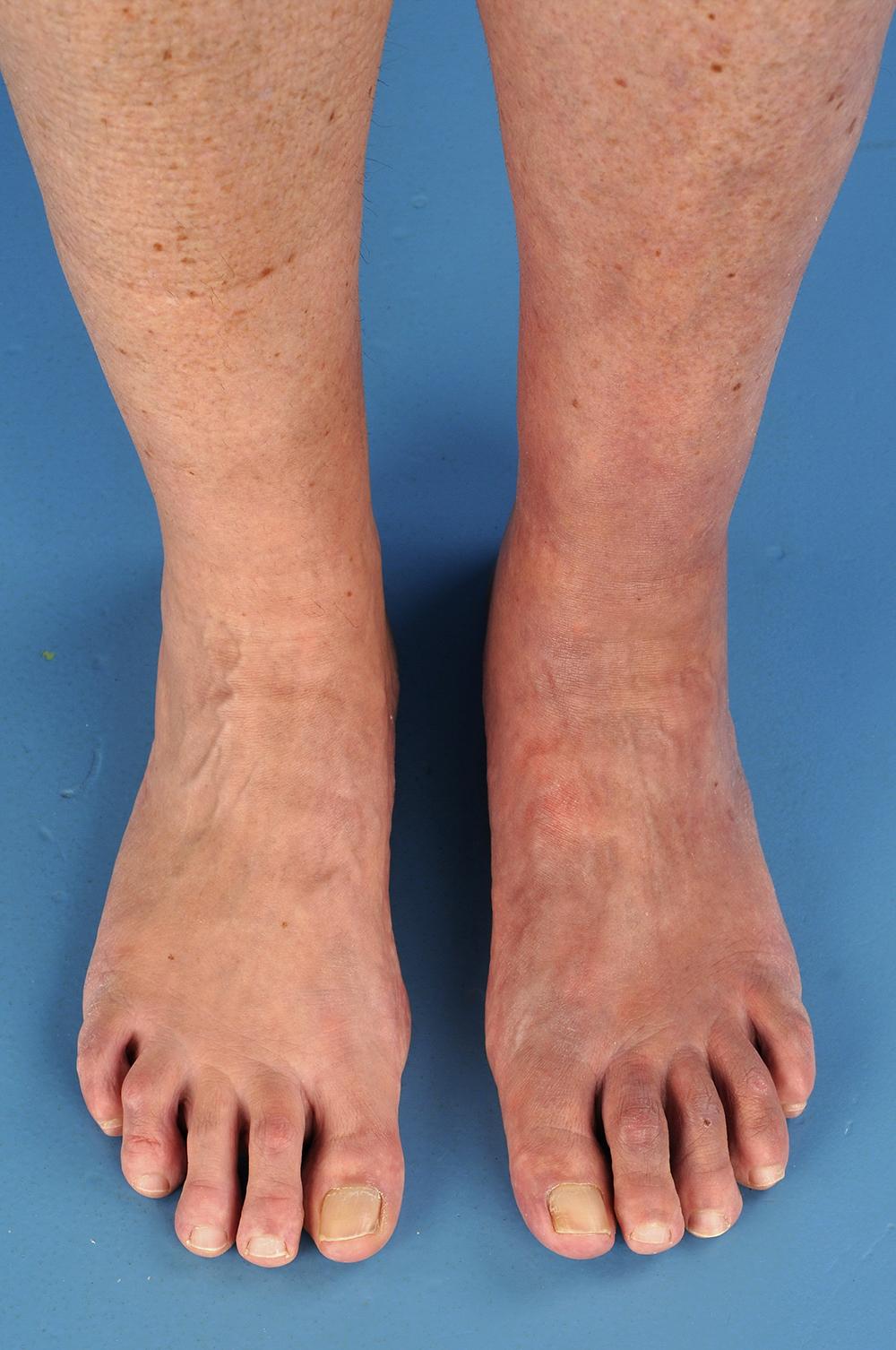 Blote voeten en onderbenen