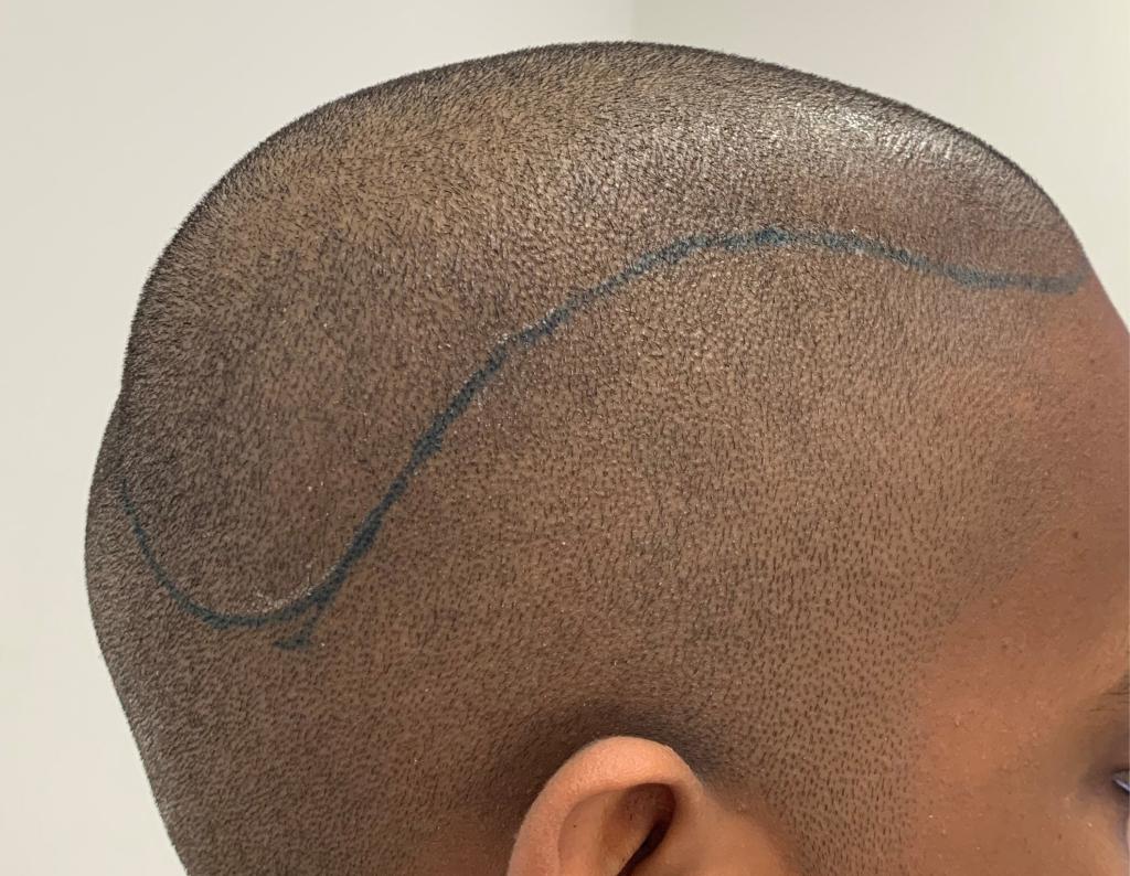 Jongen met zwelling op zijn hoofd