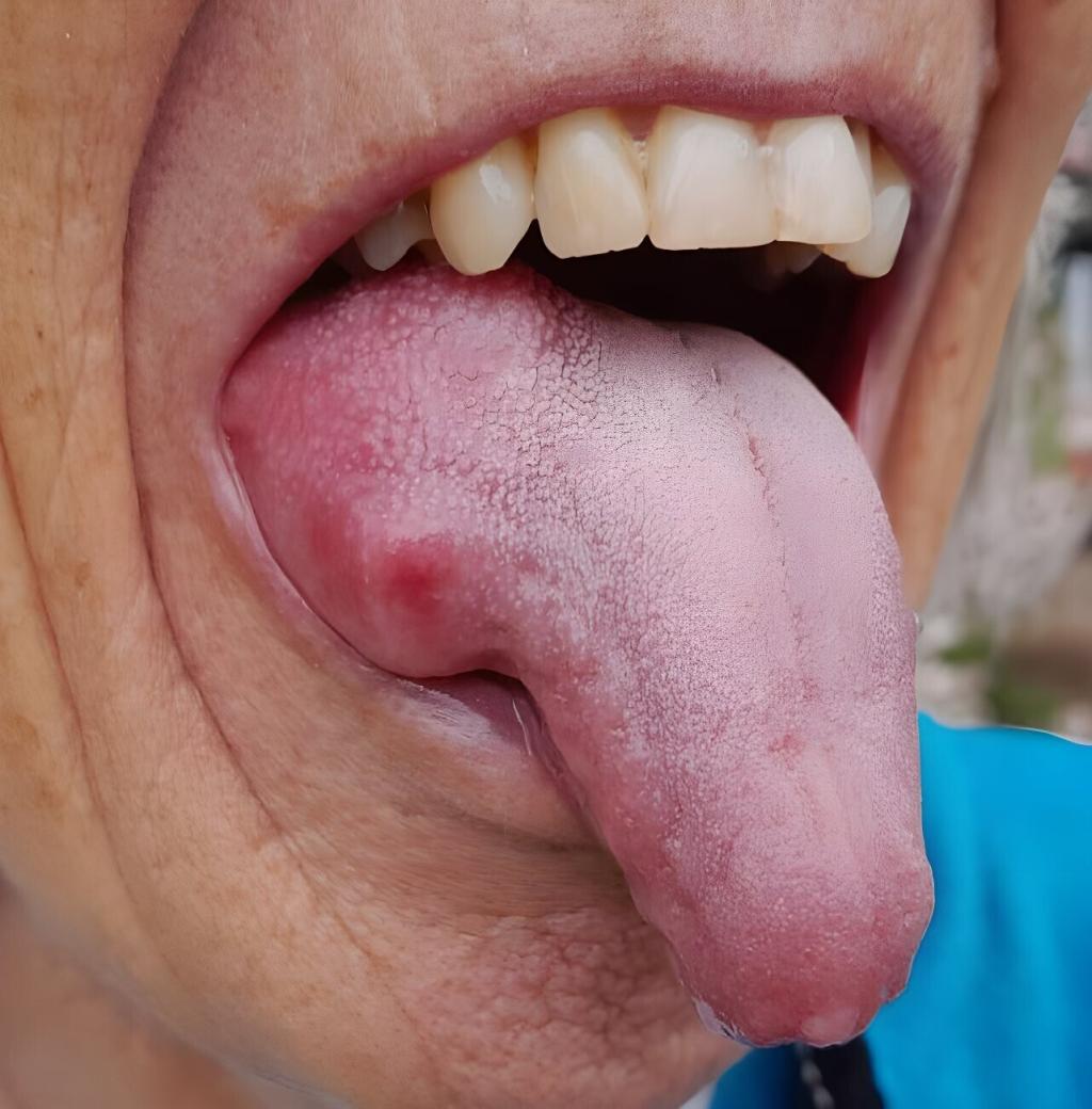 Tong met een zwelling