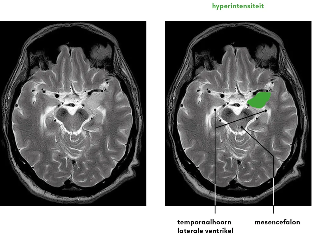 Figuur 1 | T2-gewogen MRI van het cerebrum