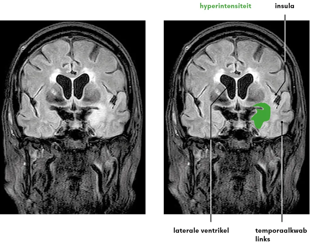 Figuur 2 | FLAIR-MRI van het cerebrum