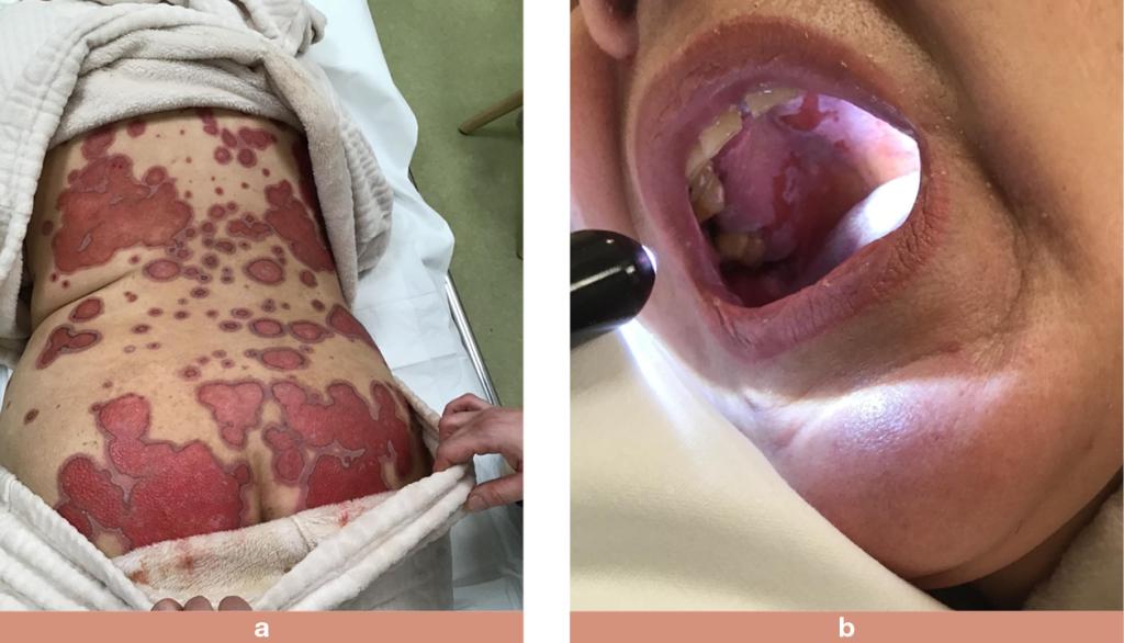 Figuur 1 | Huid- en slijmvliesreactie bij methotrexaattoxiciteit
