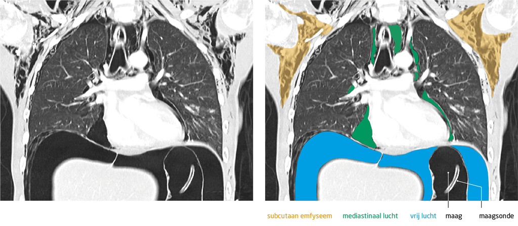 Figuur 1 | CT van de patiënte met een maagruptuur