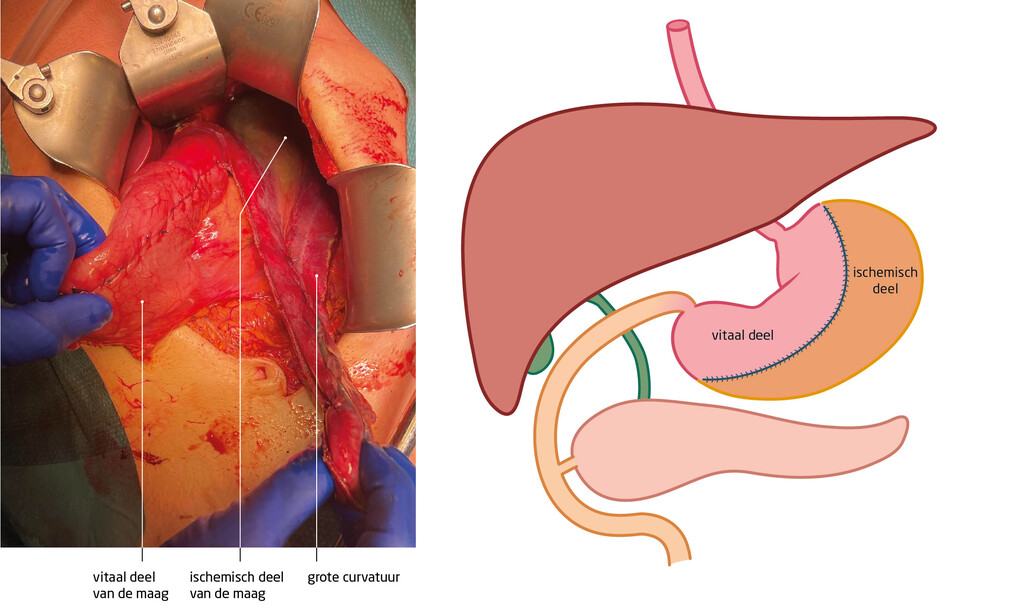 Figuur 2 | Operatieve behandeling van de maagruptuur