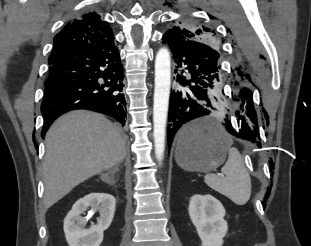 Figuur 1 | Locatie thoracocenthesekatheter bij patiënt A