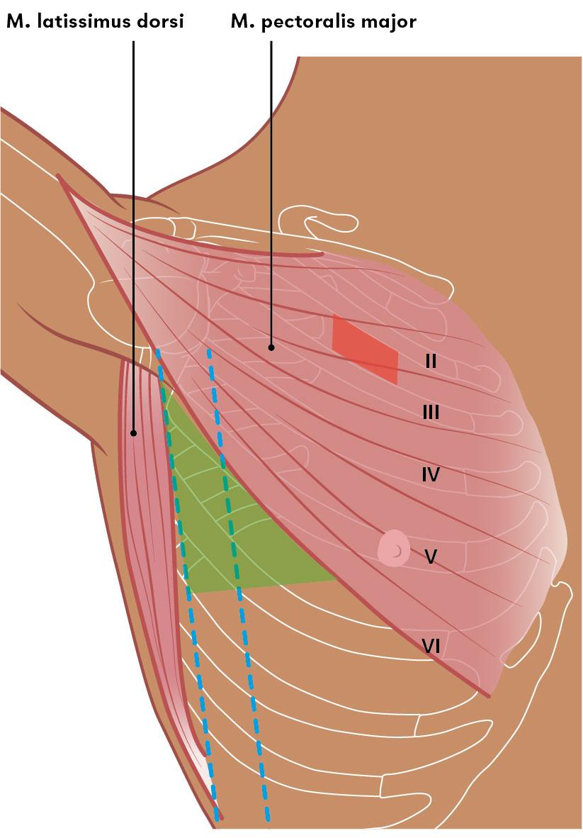 Figuur 3 | Juiste plaats thoracocenthesenaald
