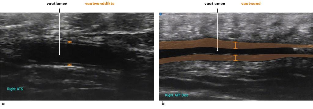 Figuur 1 | Voorbeeld van een ‘halo’ bij reuscelarteriitis