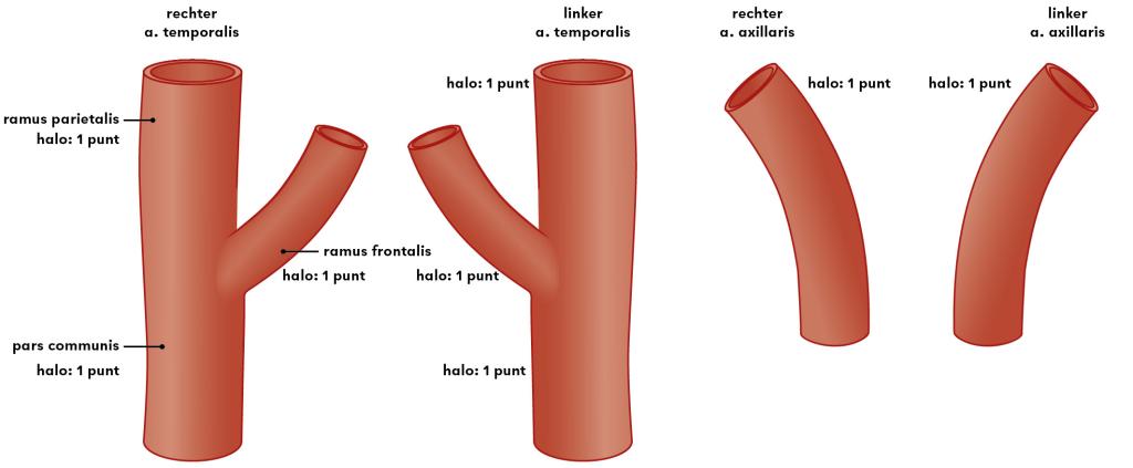 Figuur 2 | Schema voor de ‘halo count’ bij verdenking op reuscelarteriitis