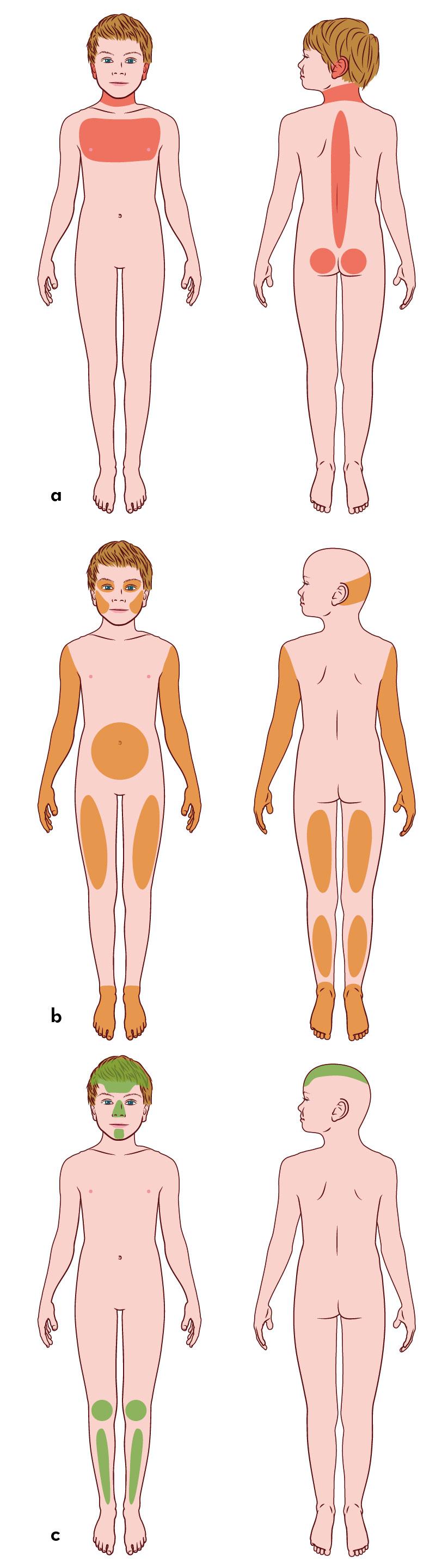 Figuur | Welke locaties van onderhuidse bloedingen zijn suggestief voor toegebracht letsel bij een kind?