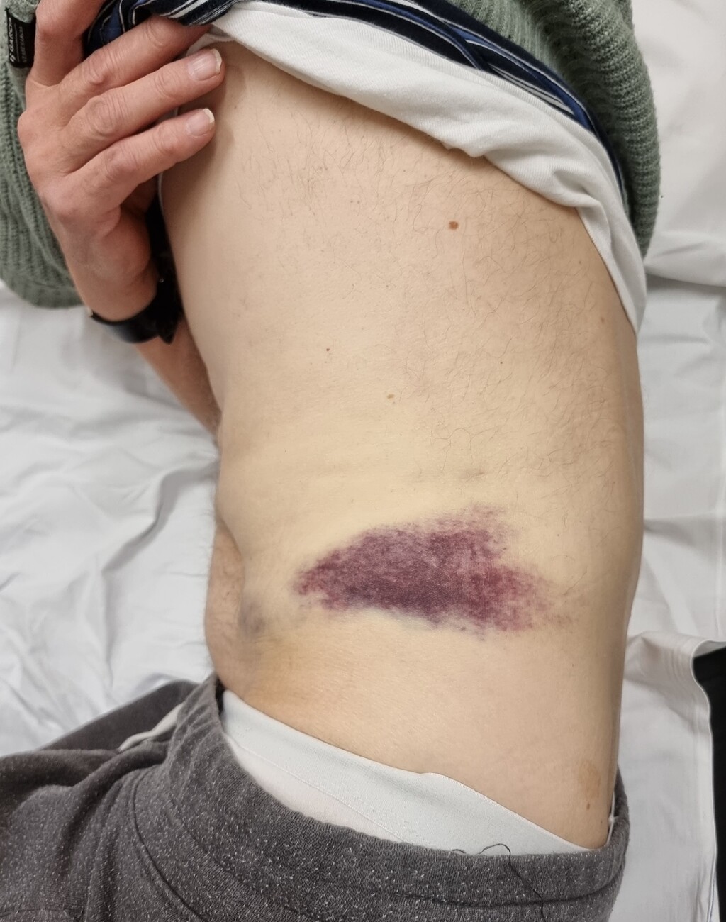 Flank met bloeduitstortingen