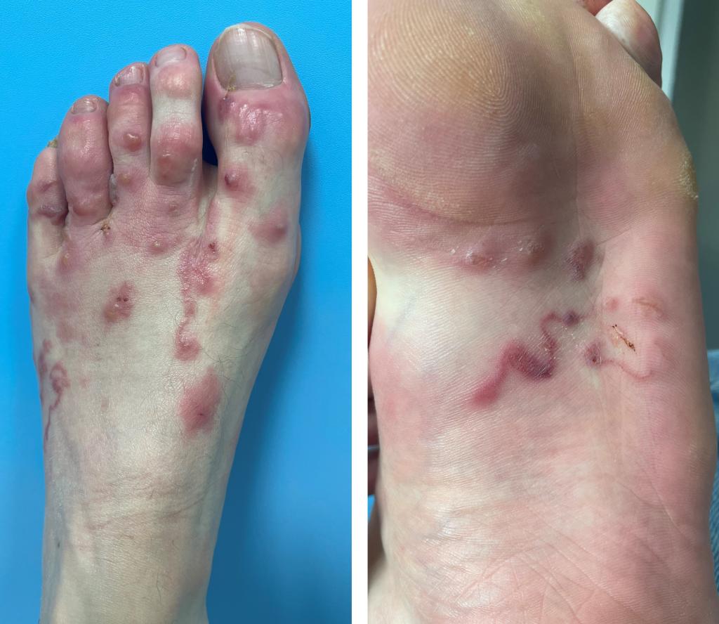 Figuur | Cutane larva migrans