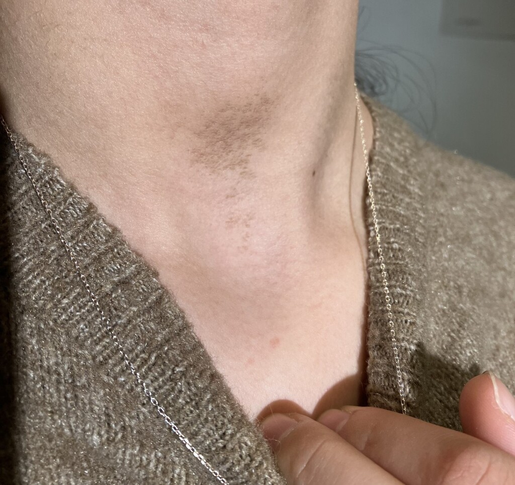 Verkleuring in de hals