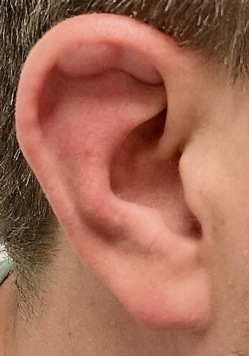 Oorschelp met afwijking